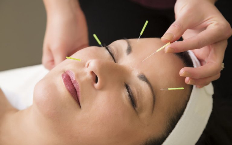 cosmetic acupuncture
