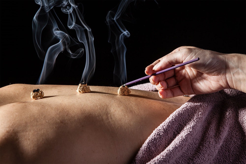 moxibustion